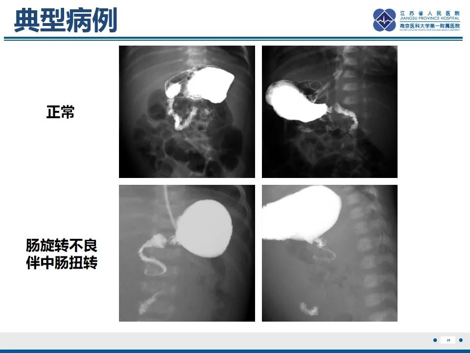 影像PPT - 【PPT】先天性肠旋转不良伴中肠扭转-26