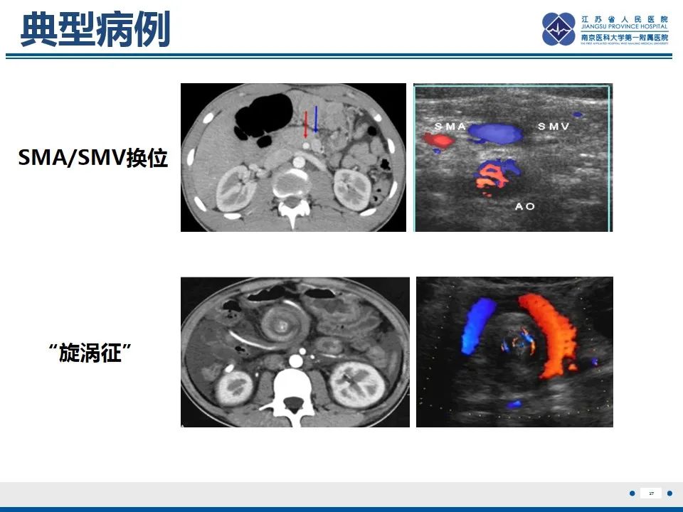 影像PPT - 【PPT】先天性肠旋转不良伴中肠扭转-28