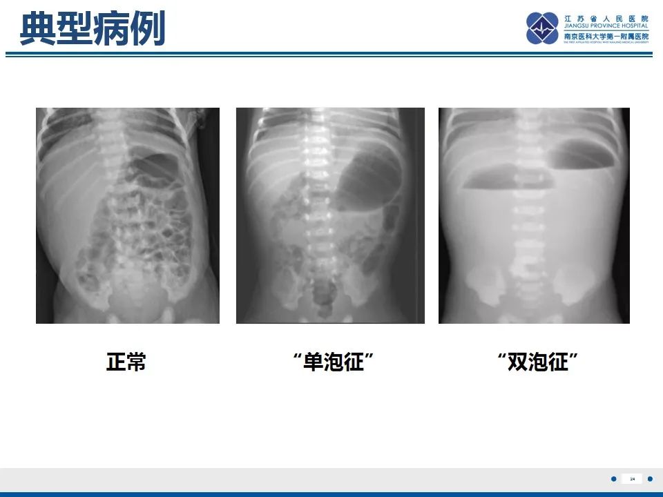 影像PPT - 【PPT】先天性肠旋转不良伴中肠扭转-25