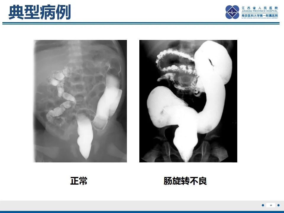 影像PPT - 【PPT】先天性肠旋转不良伴中肠扭转-27