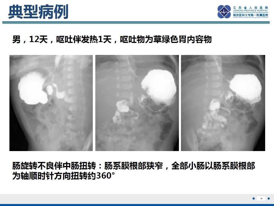 影像PPT - 【PPT】先天性肠旋转不良伴中肠扭转-29
