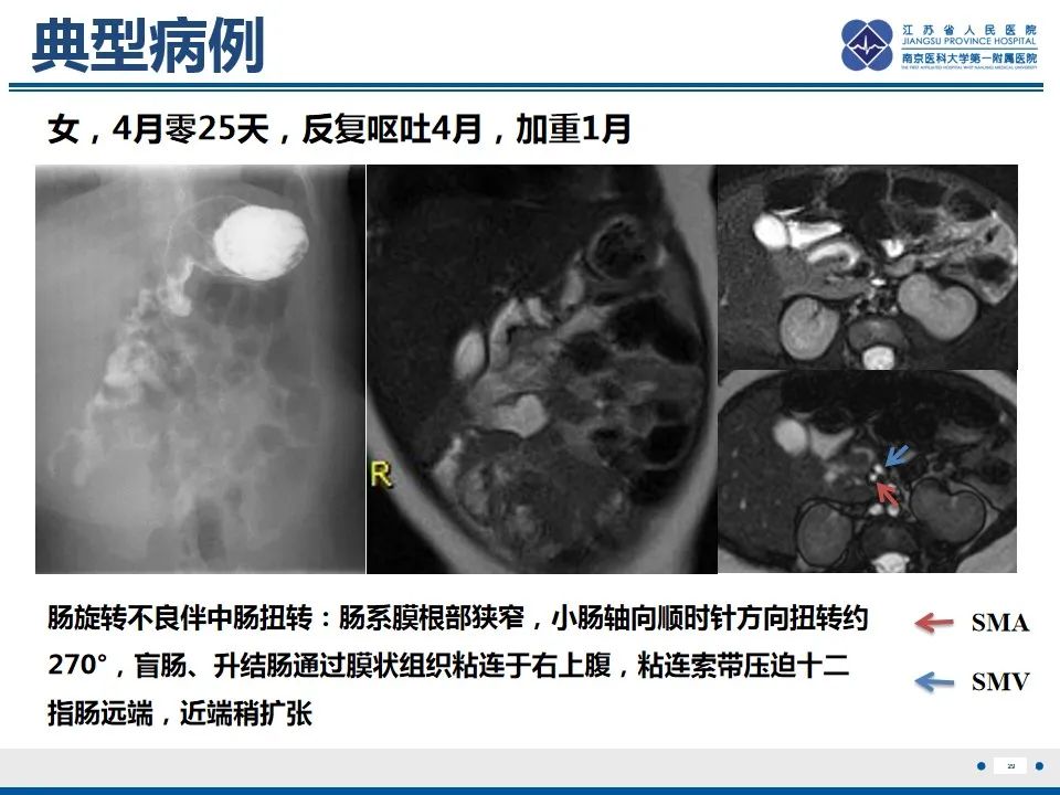 影像PPT - 【PPT】先天性肠旋转不良伴中肠扭转-30