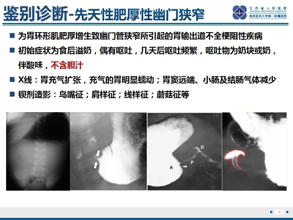影像PPT - 【PPT】先天性肠旋转不良伴中肠扭转-32
