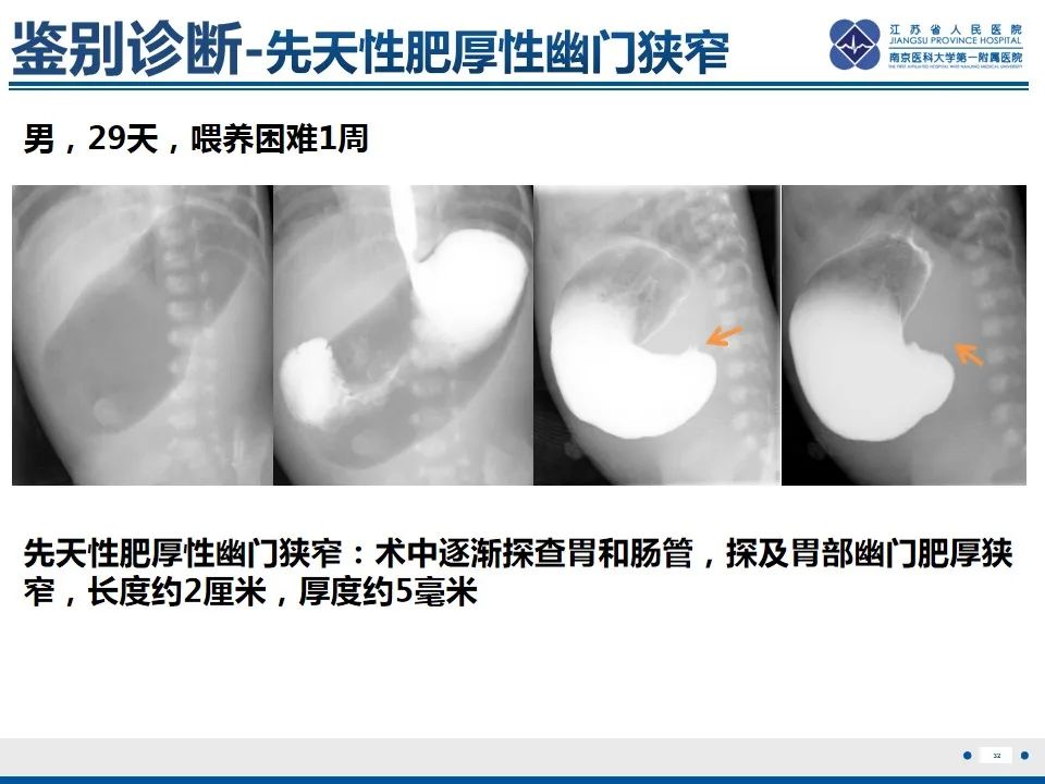 影像PPT - 【PPT】先天性肠旋转不良伴中肠扭转-33
