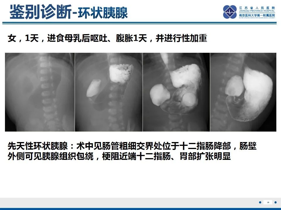 影像PPT - 【PPT】先天性肠旋转不良伴中肠扭转-36