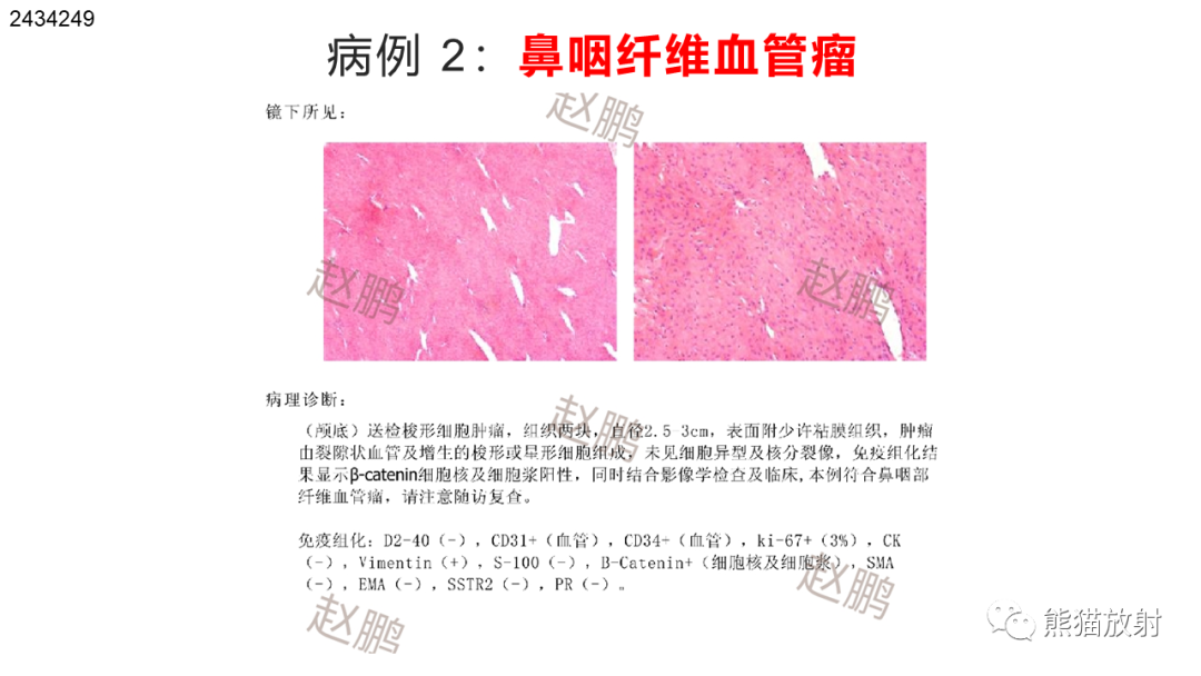 影像PPT - 【PPT】嗅神经母细胞瘤 VS 鼻咽纤维血管瘤-28