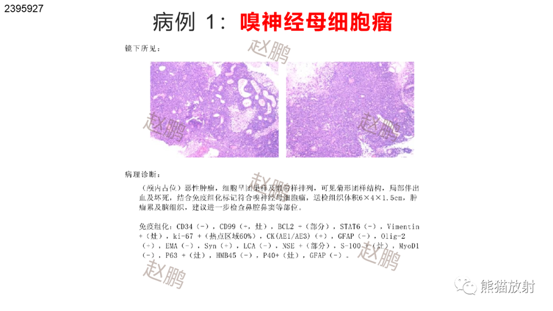 影像PPT - 【PPT】嗅神经母细胞瘤 VS 鼻咽纤维血管瘤-27