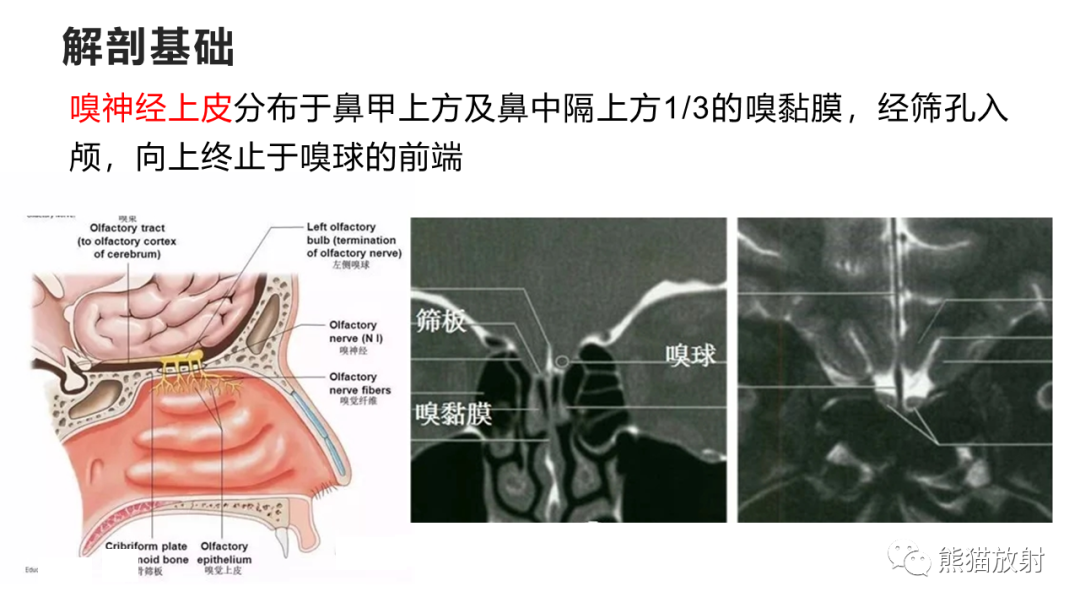 影像PPT - 【PPT】嗅神经母细胞瘤 VS 鼻咽纤维血管瘤-30