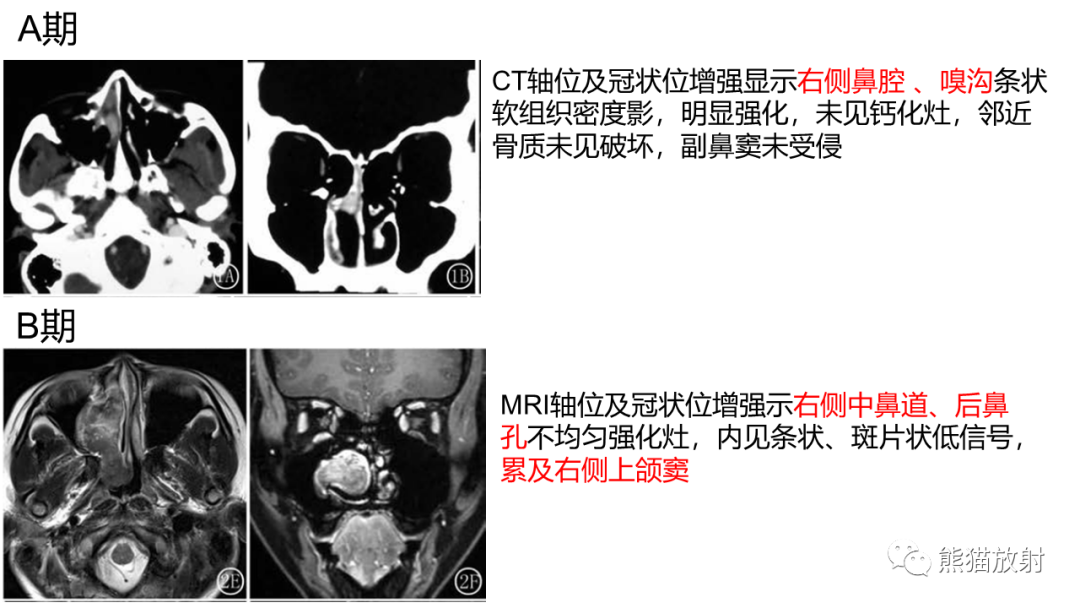 影像PPT - 【PPT】嗅神经母细胞瘤 VS 鼻咽纤维血管瘤-34