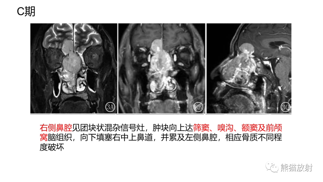 影像PPT - 【PPT】嗅神经母细胞瘤 VS 鼻咽纤维血管瘤-35