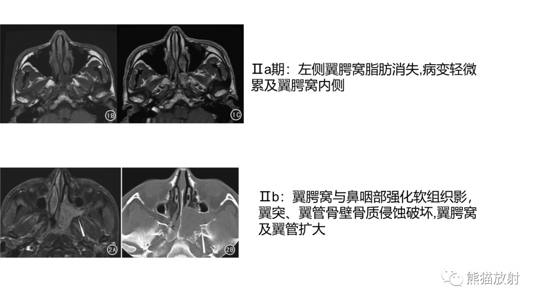 影像PPT - 【PPT】嗅神经母细胞瘤 VS 鼻咽纤维血管瘤-40