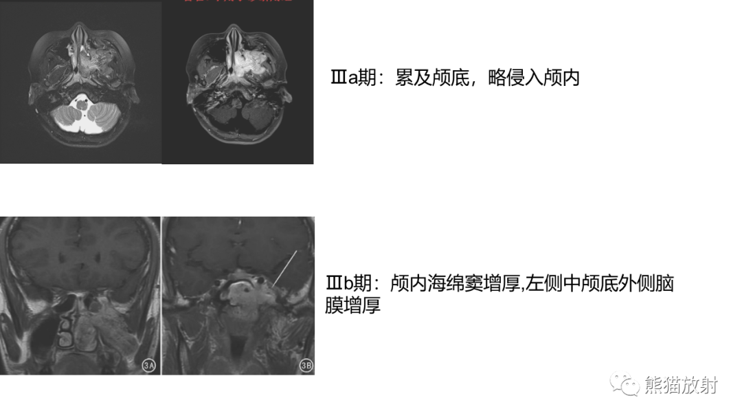 影像PPT - 【PPT】嗅神经母细胞瘤 VS 鼻咽纤维血管瘤-41