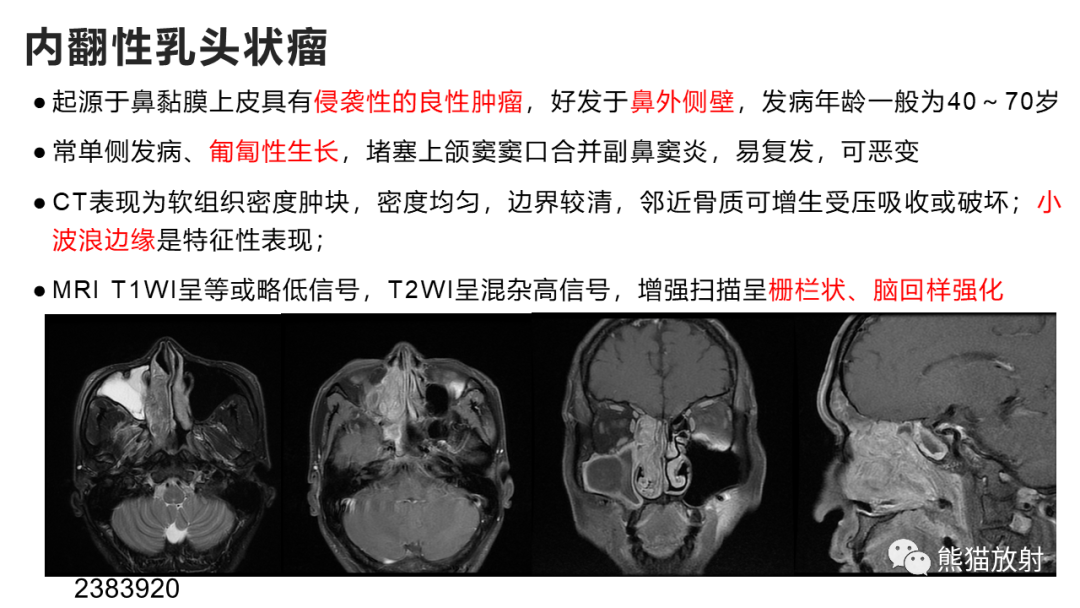 影像PPT - 【PPT】嗅神经母细胞瘤 VS 鼻咽纤维血管瘤-42