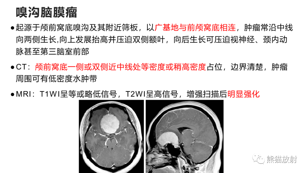 影像PPT - 【PPT】嗅神经母细胞瘤 VS 鼻咽纤维血管瘤-45