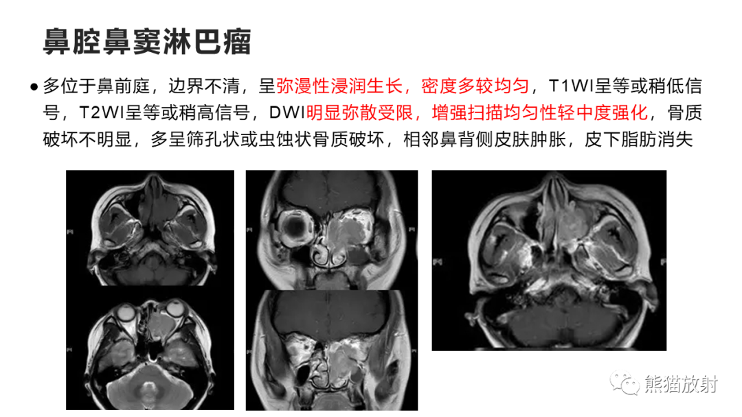 影像PPT - 【PPT】嗅神经母细胞瘤 VS 鼻咽纤维血管瘤-43
