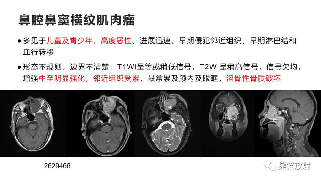 影像PPT - 【PPT】嗅神经母细胞瘤 VS 鼻咽纤维血管瘤-44