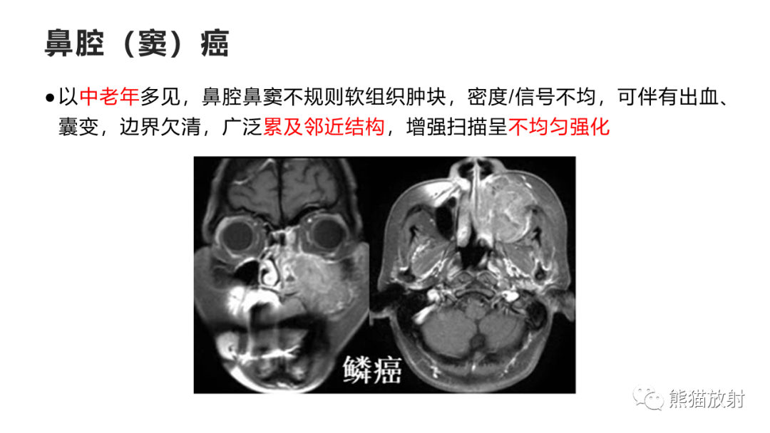 影像PPT - 【PPT】嗅神经母细胞瘤 VS 鼻咽纤维血管瘤-46