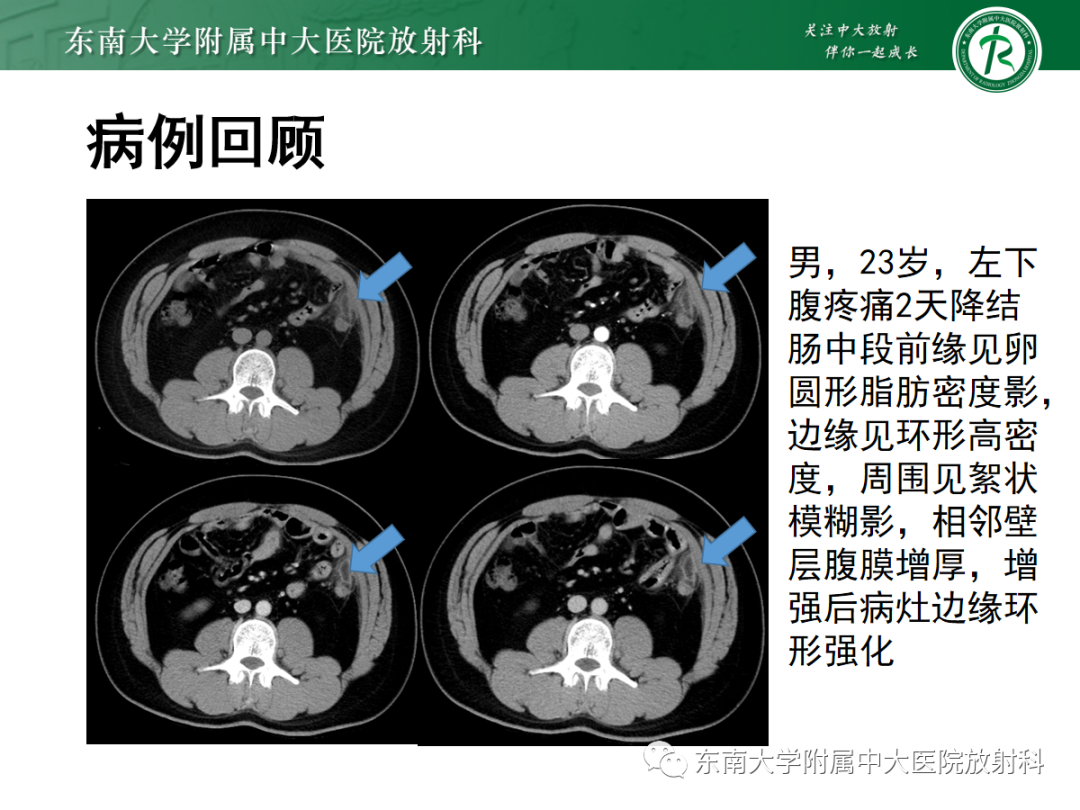 影像PPT - 【PPT】原发性肠脂垂炎-2