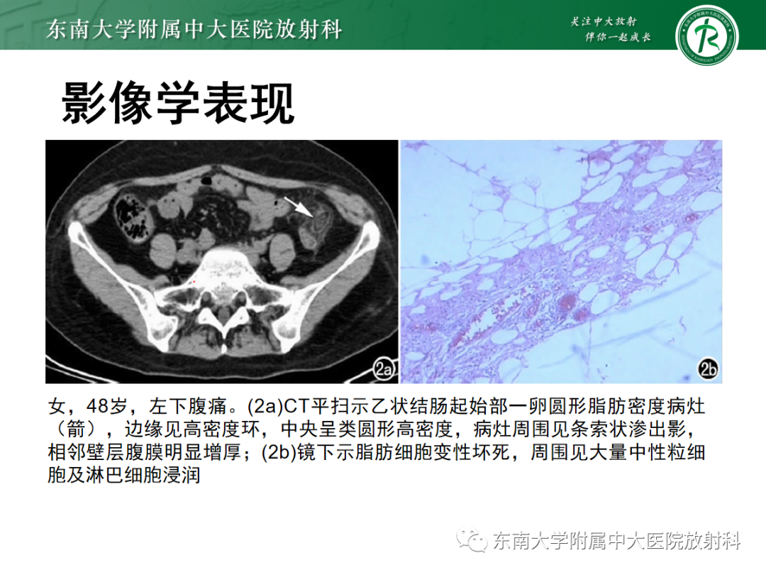 影像PPT - 【PPT】原发性肠脂垂炎-11