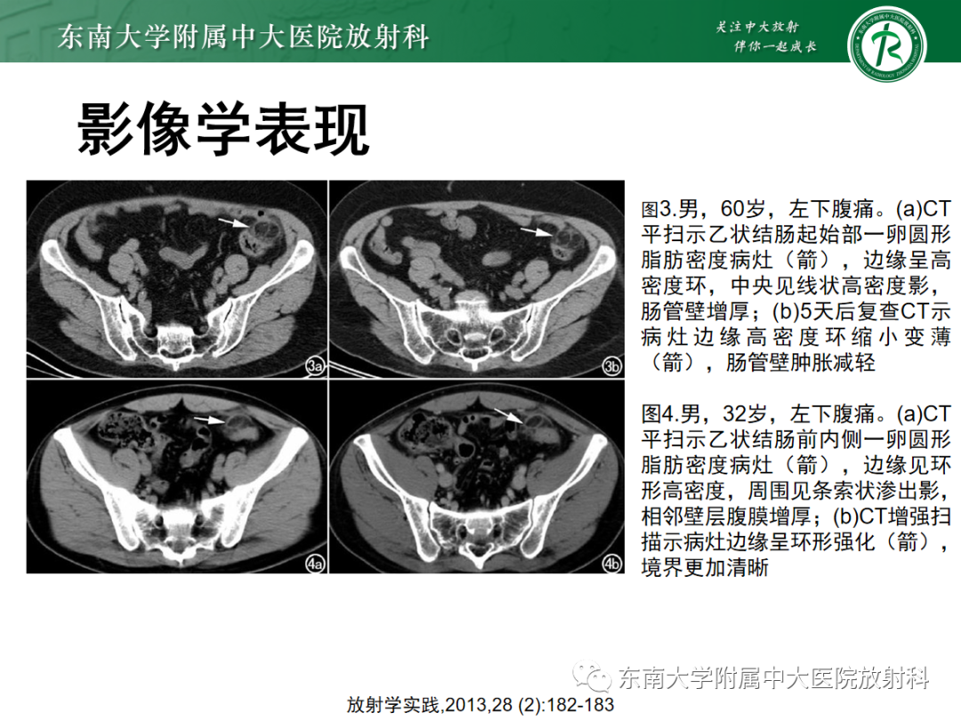 影像PPT - 【PPT】原发性肠脂垂炎-12