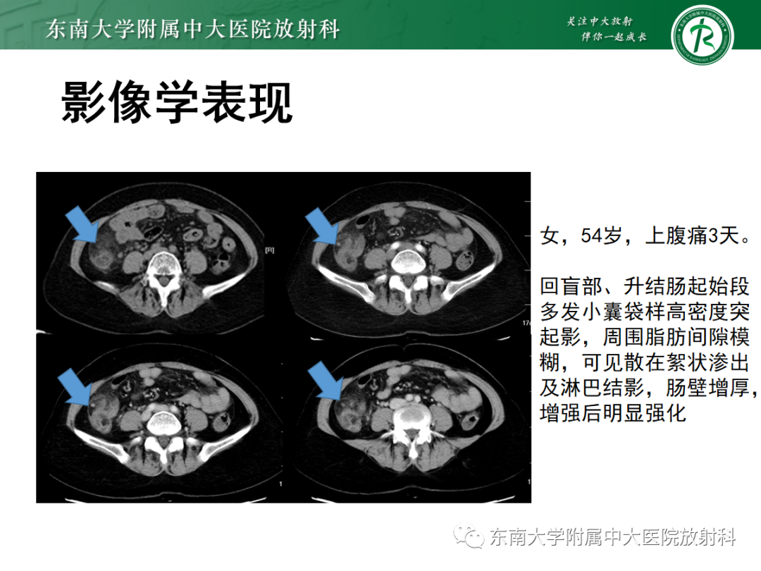 影像PPT - 【PPT】原发性肠脂垂炎-14