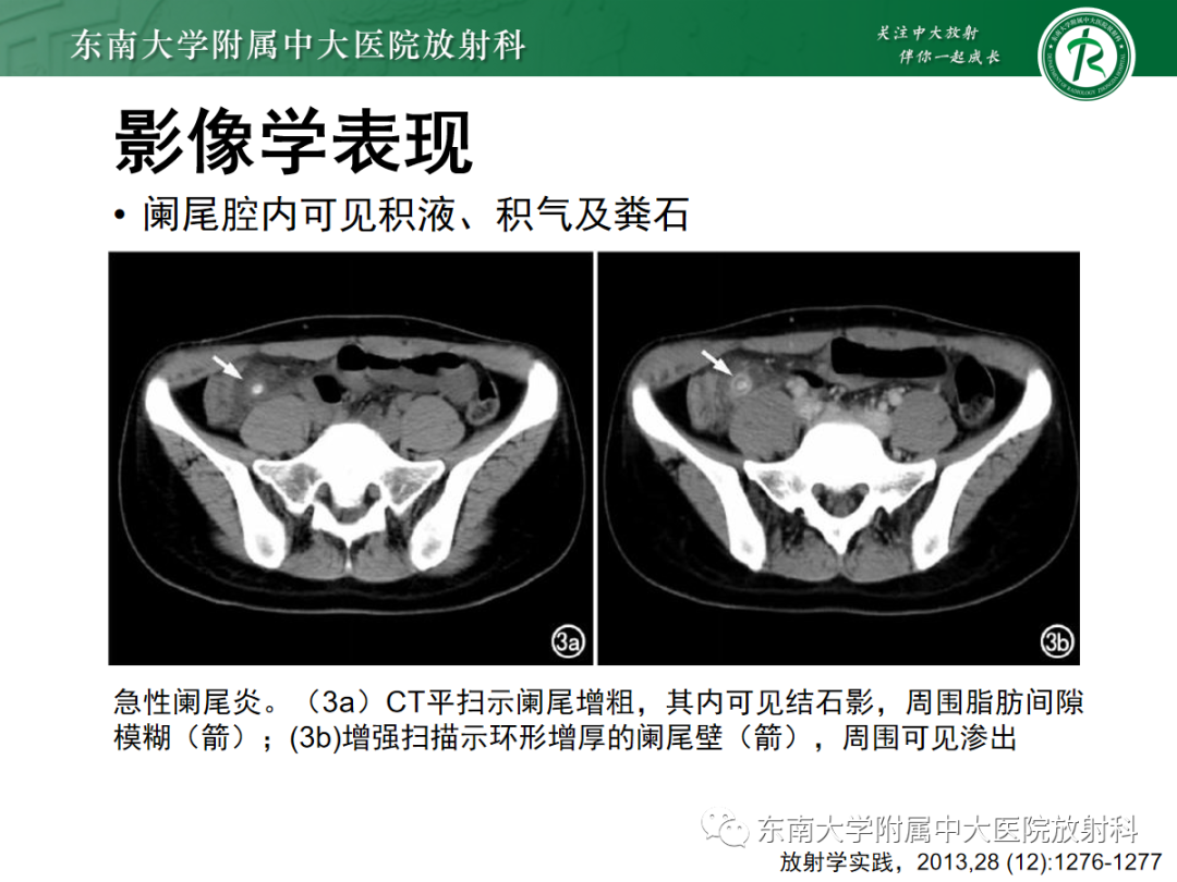 影像PPT - 【PPT】原发性肠脂垂炎-19