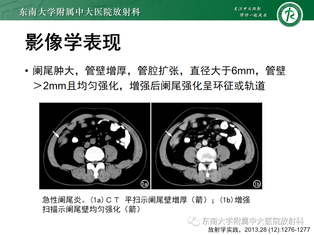 影像PPT - 【PPT】原发性肠脂垂炎-18
