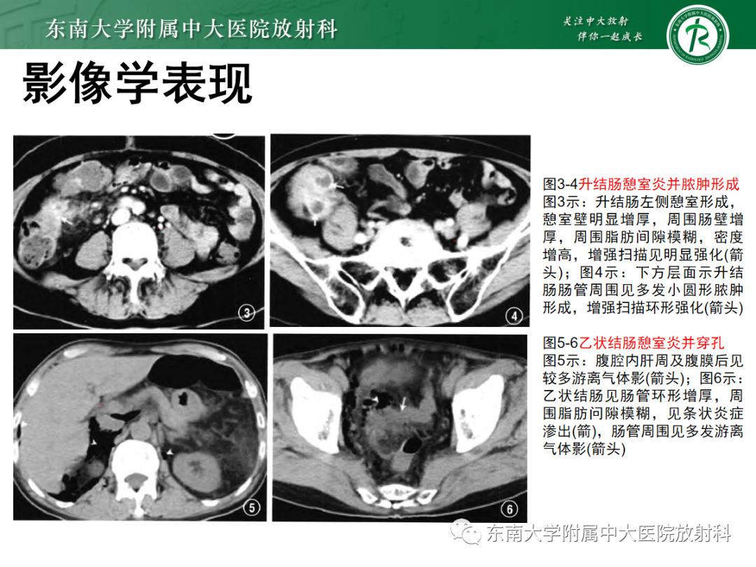 影像PPT - 【PPT】原发性肠脂垂炎-15