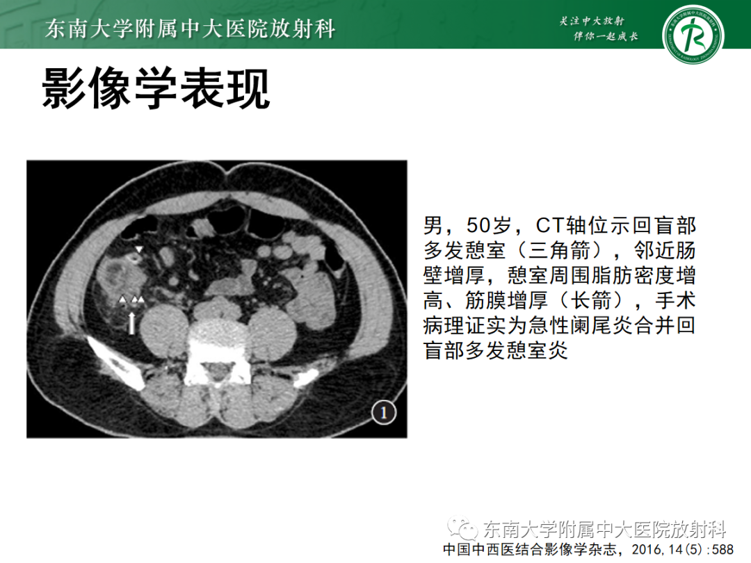 影像PPT - 【PPT】原发性肠脂垂炎-16