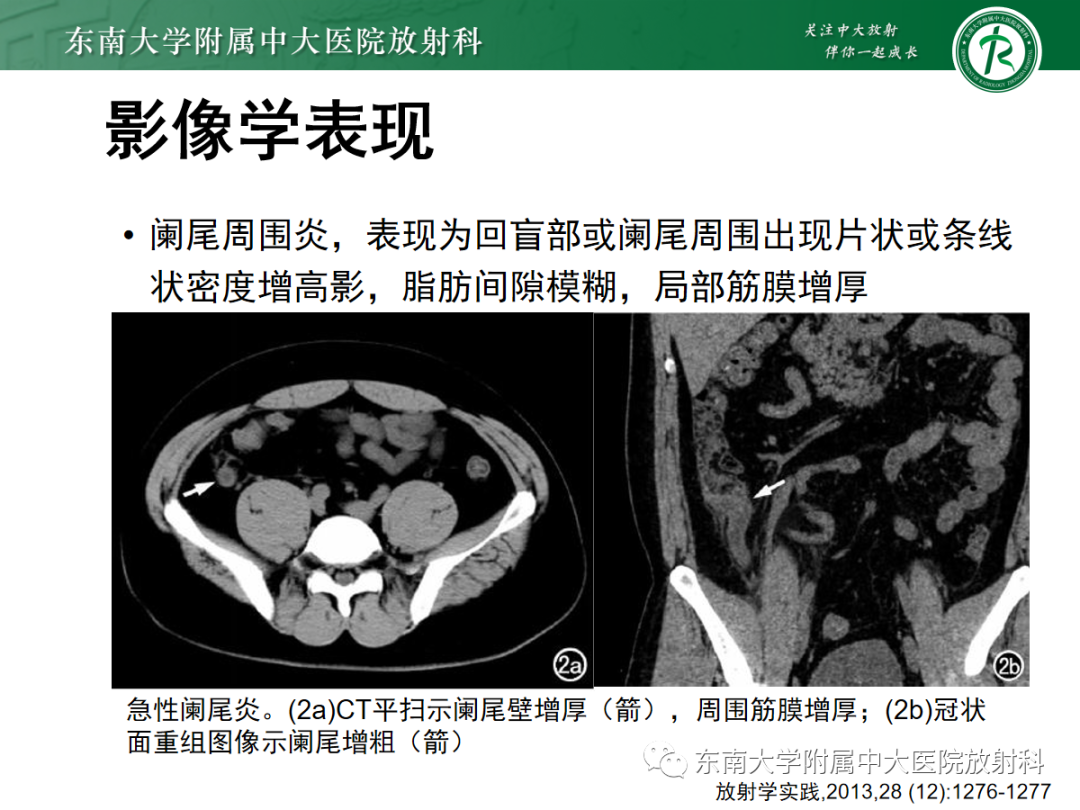 影像PPT - 【PPT】原发性肠脂垂炎-20