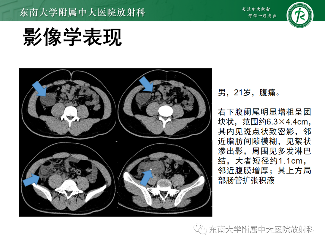 影像PPT - 【PPT】原发性肠脂垂炎-23