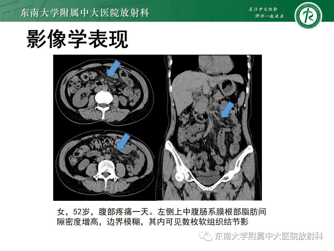 影像PPT - 【PPT】原发性肠脂垂炎-26