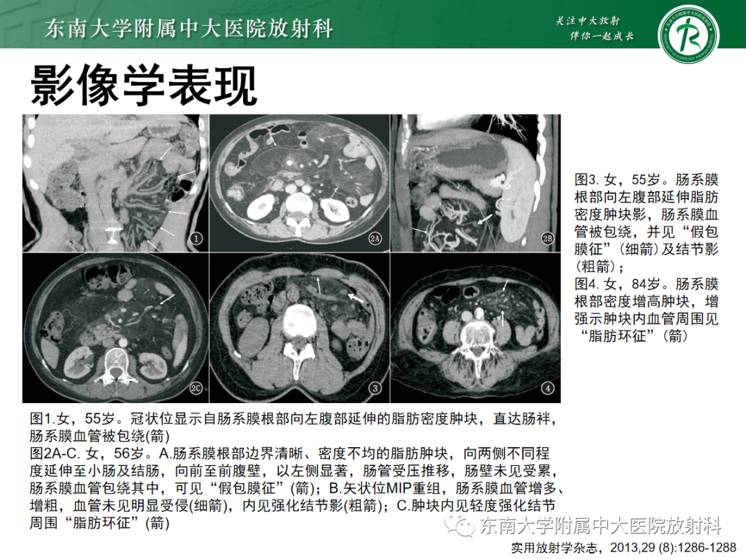 影像PPT - 【PPT】原发性肠脂垂炎-27