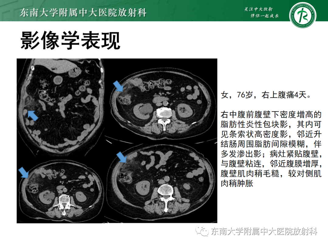 影像PPT - 【PPT】原发性肠脂垂炎-30