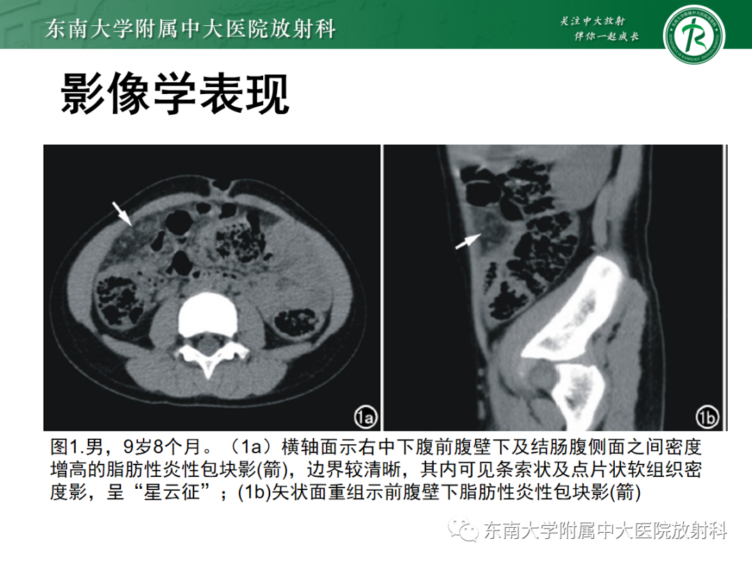 影像PPT - 【PPT】原发性肠脂垂炎-31