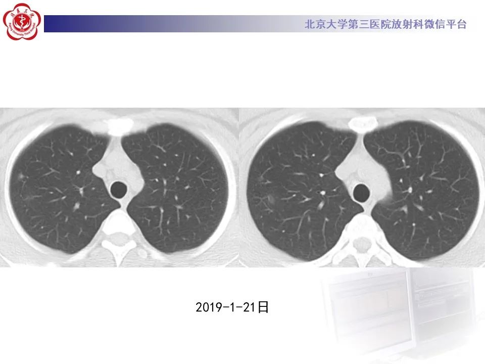 影像PPT - 【PPT】肺子宫内膜异位症-3