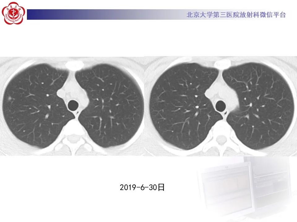 影像PPT - 【PPT】肺子宫内膜异位症-7