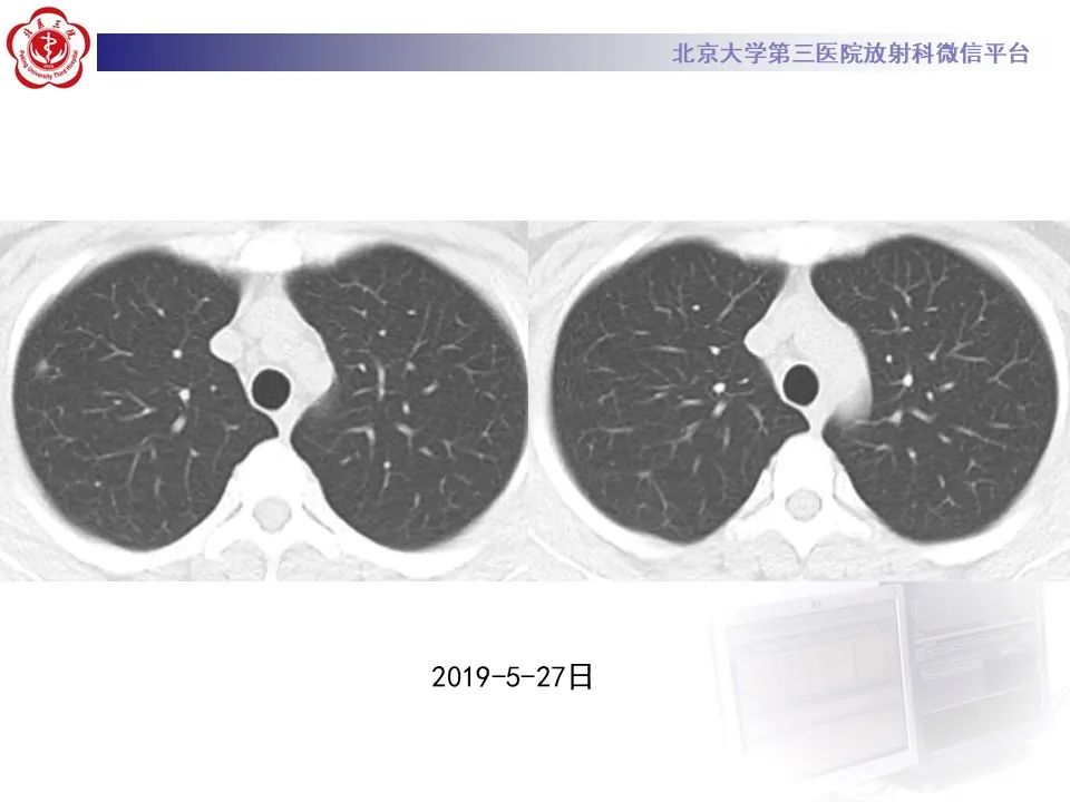 影像PPT - 【PPT】肺子宫内膜异位症-5