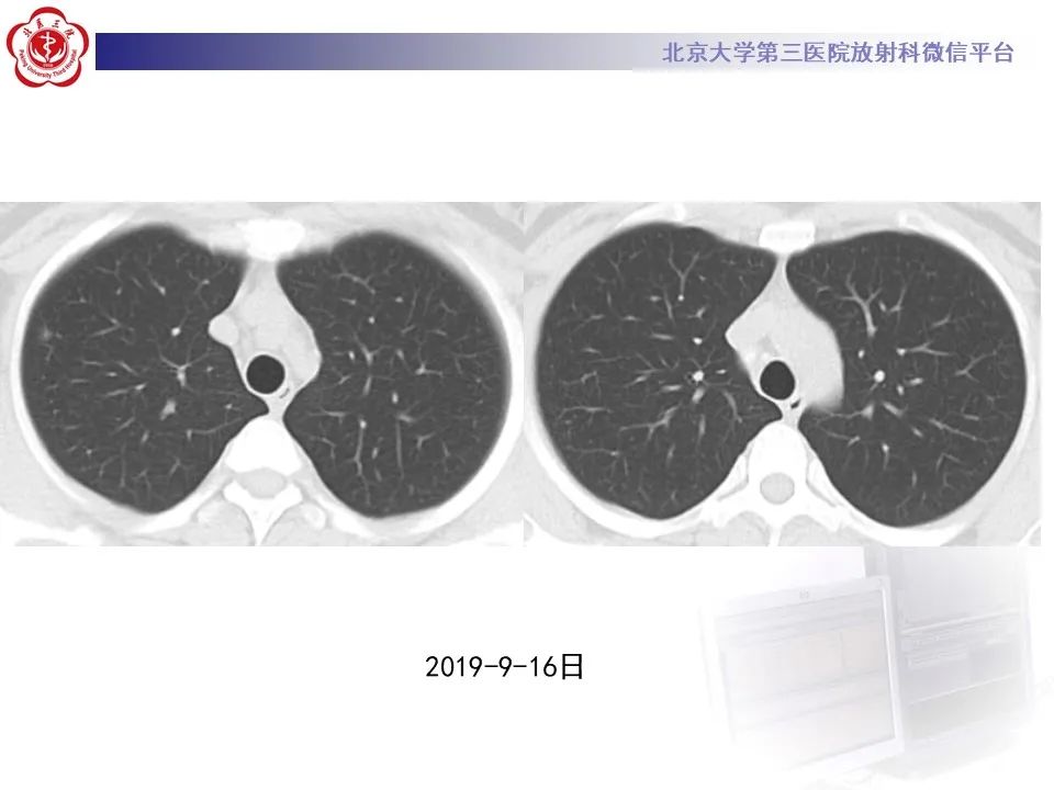 影像PPT - 【PPT】肺子宫内膜异位症-11