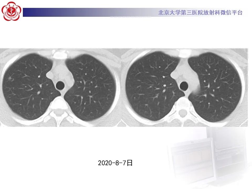 影像PPT - 【PPT】肺子宫内膜异位症-13