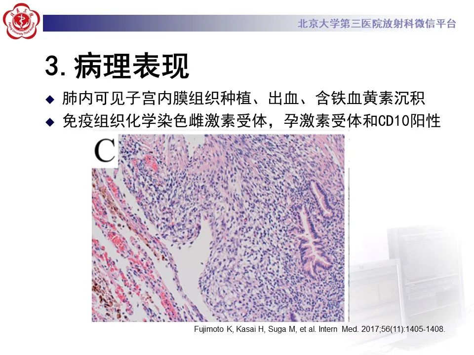 影像PPT - 【PPT】肺子宫内膜异位症-19