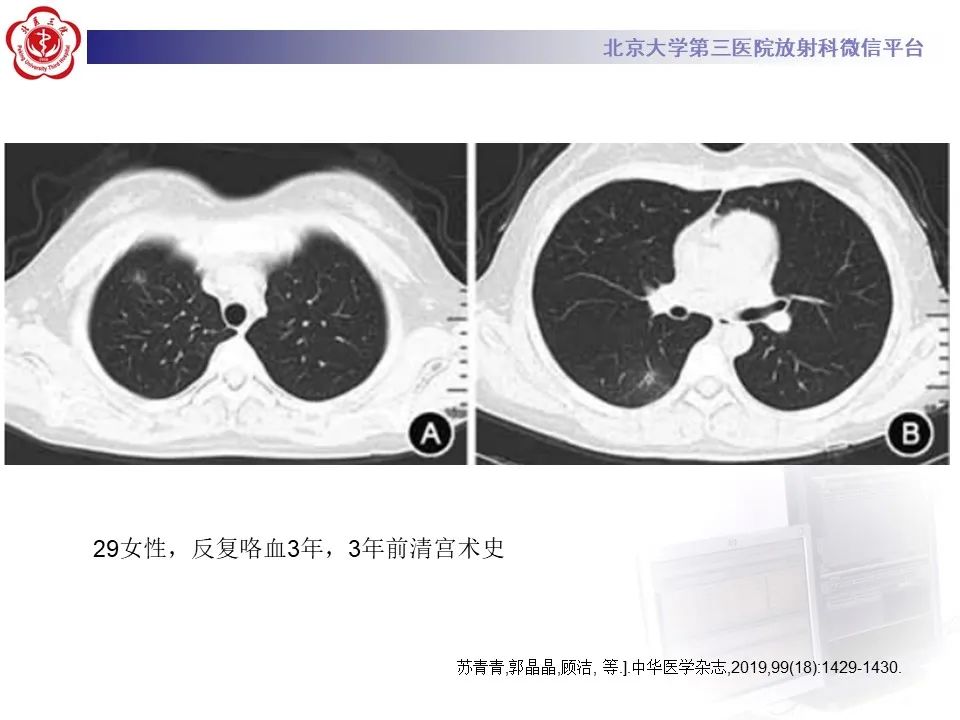 影像PPT - 【PPT】肺子宫内膜异位症-25