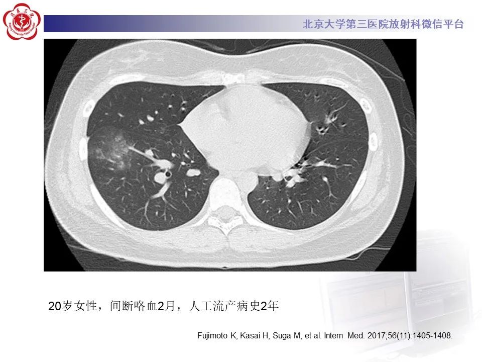 影像PPT - 【PPT】肺子宫内膜异位症-26