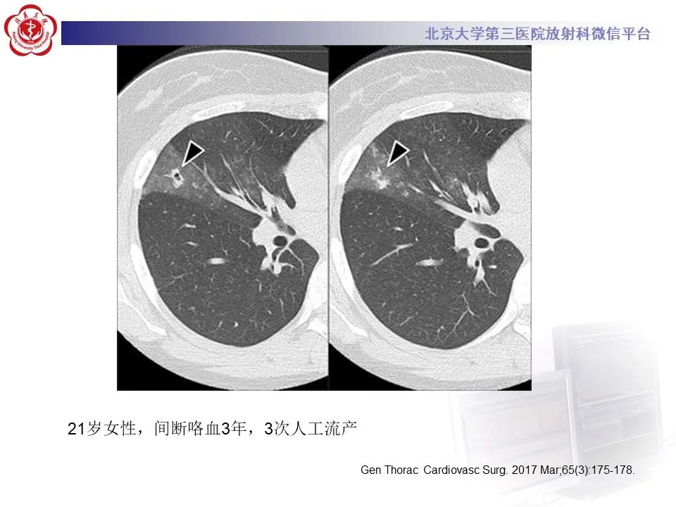 影像PPT - 【PPT】肺子宫内膜异位症-28