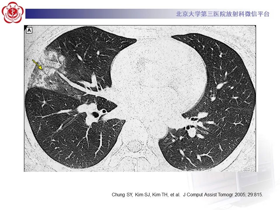 影像PPT - 【PPT】肺子宫内膜异位症-27
