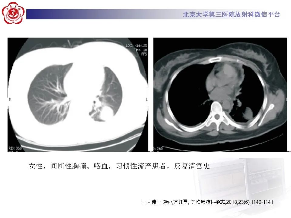 影像PPT - 【PPT】肺子宫内膜异位症-29