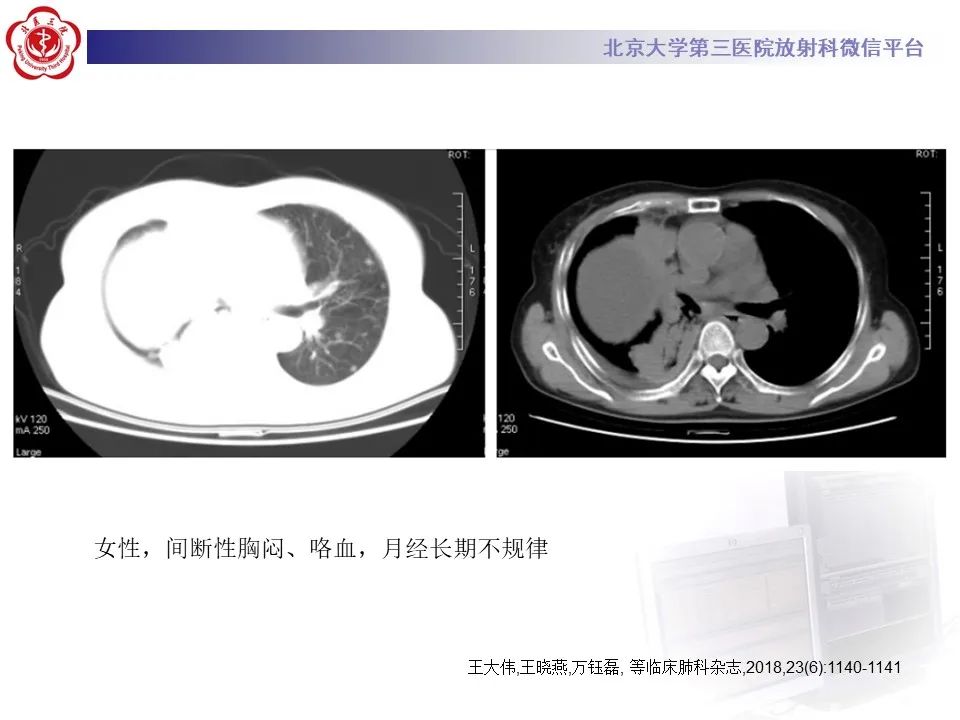 影像PPT - 【PPT】肺子宫内膜异位症-30