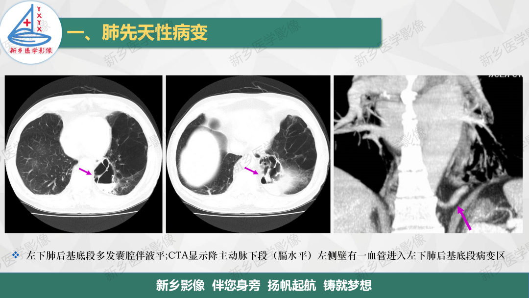 影像PPT - 【PPT】医学影像诊断学教材解读—肺部病变-6