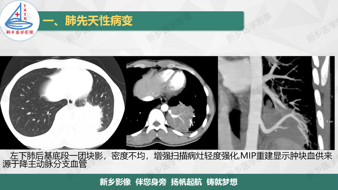 影像PPT - 【PPT】医学影像诊断学教材解读—肺部病变-7
