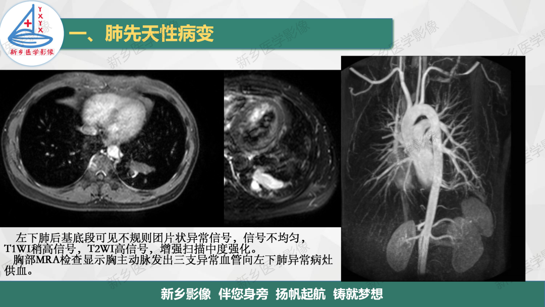 影像PPT - 【PPT】医学影像诊断学教材解读—肺部病变-8